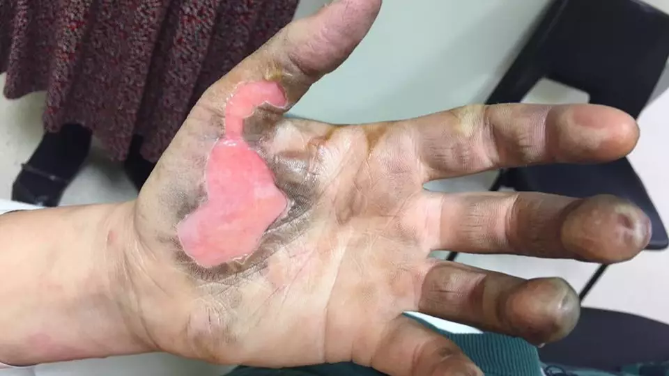 Woman Suffers Horrific Burns After Vape Battery Explodes In Her Pocket