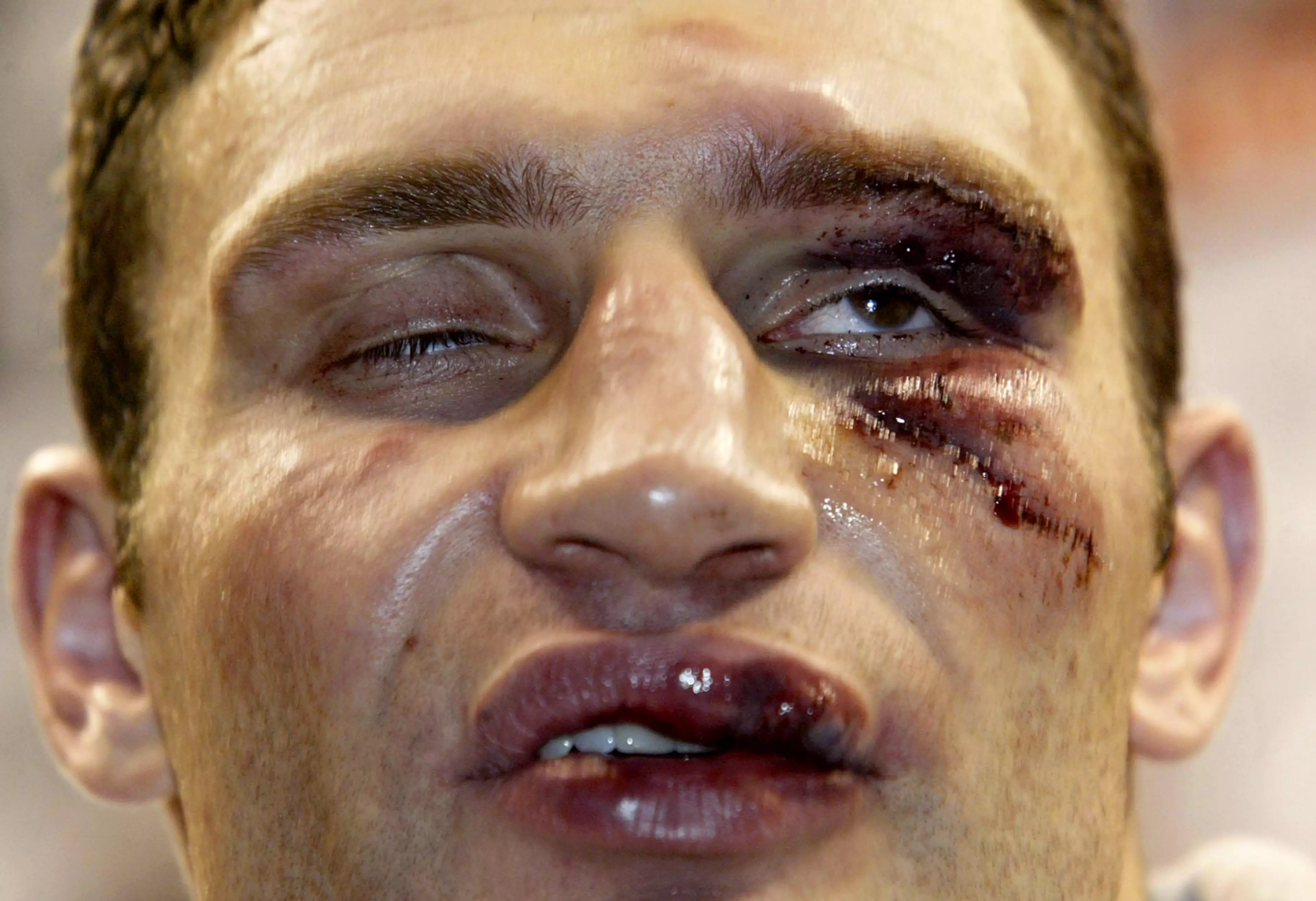 Vitali's battered face. Image: PA