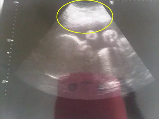 The lump containing the twin's body parts.