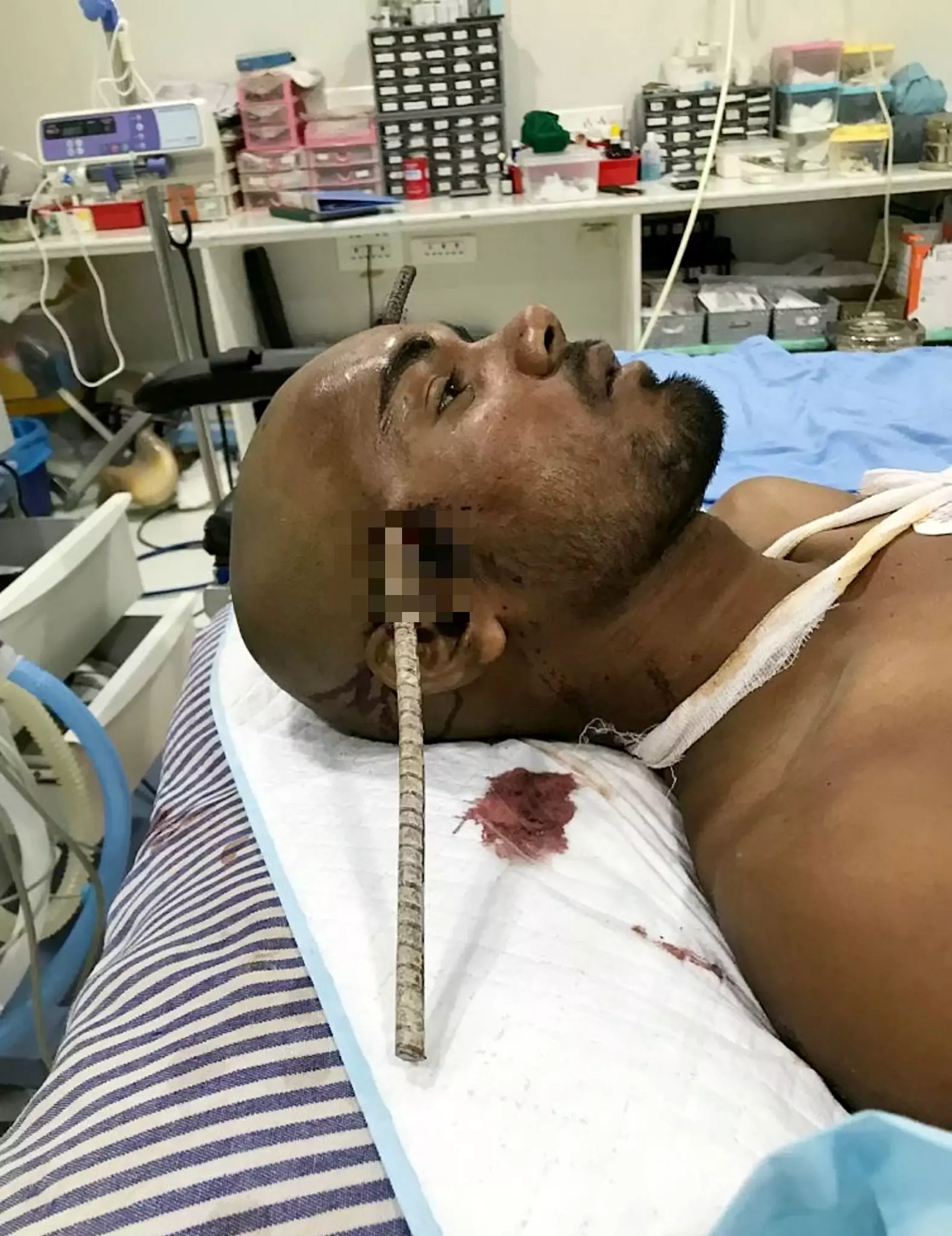Sanjay Bahe's injuries after he was impaled through the head.