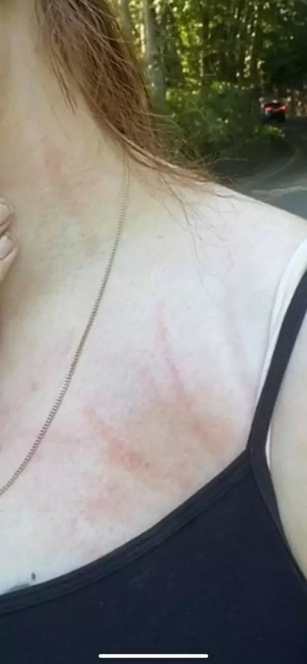 Leah was left with scratches on her neck and face (