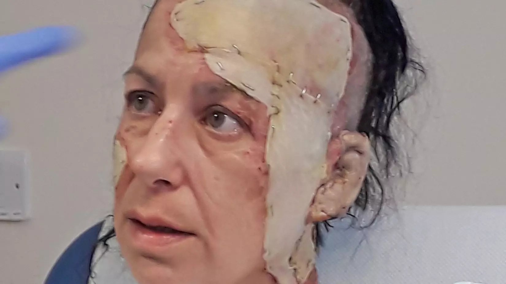 Mum Accidentally Set Her Face On Fire While Lighting A Cigarette