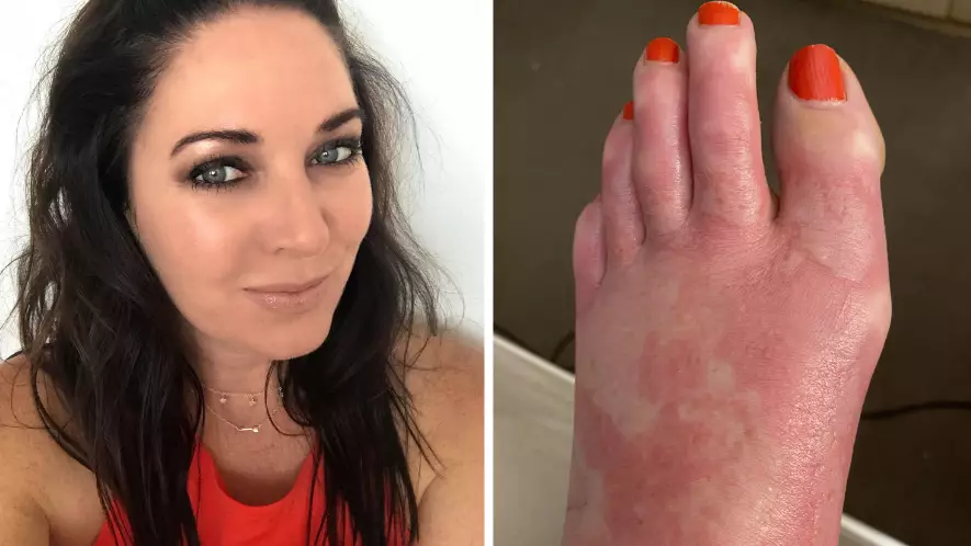 Woman Suffers Burns After Margarita Spilt On Foot