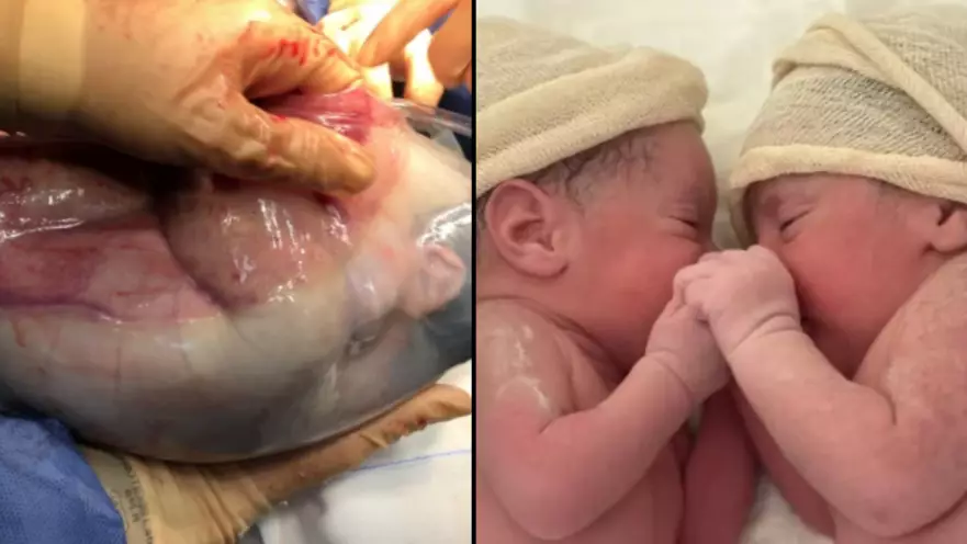 ​Twin Born Still Inside Amniotic Sac In Very Rare Event