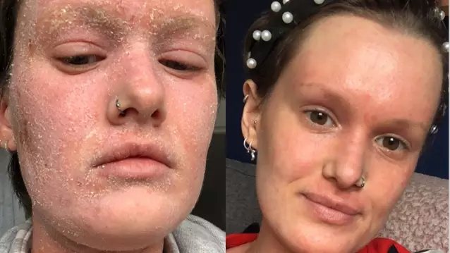 Woman With Severe Eczema Reveals Condition Leaves Her Feeling Like Her Skin Is 'On Fire'
