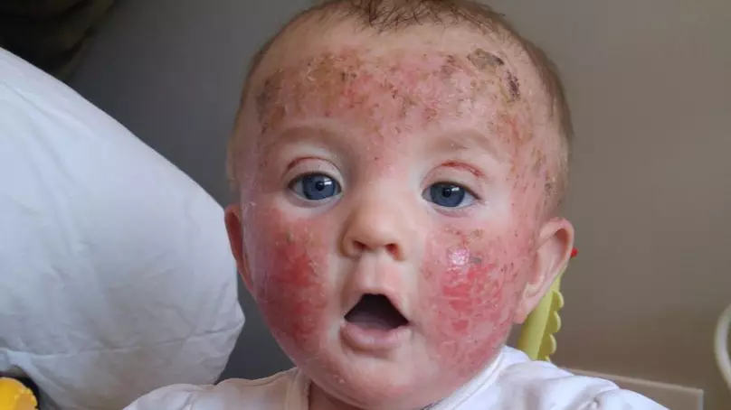 Mother Warns About Steroid Medication After It Causes Her Daughter's Skin To Burn