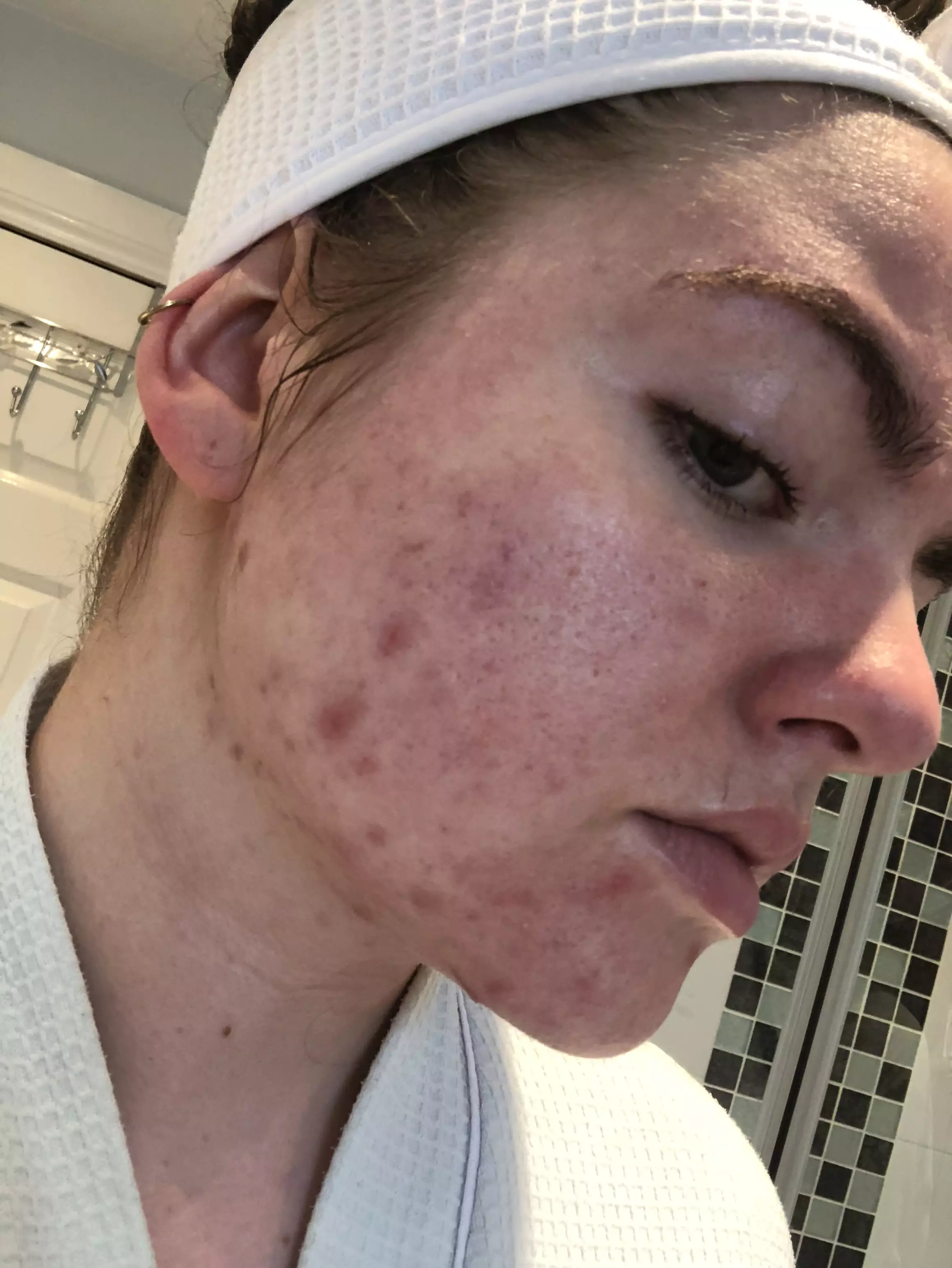 Vanessa's acne used to knock her confidence (