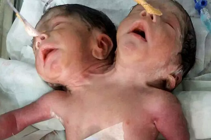 Conjoined Twins Die 32 Hours After Being Born In India