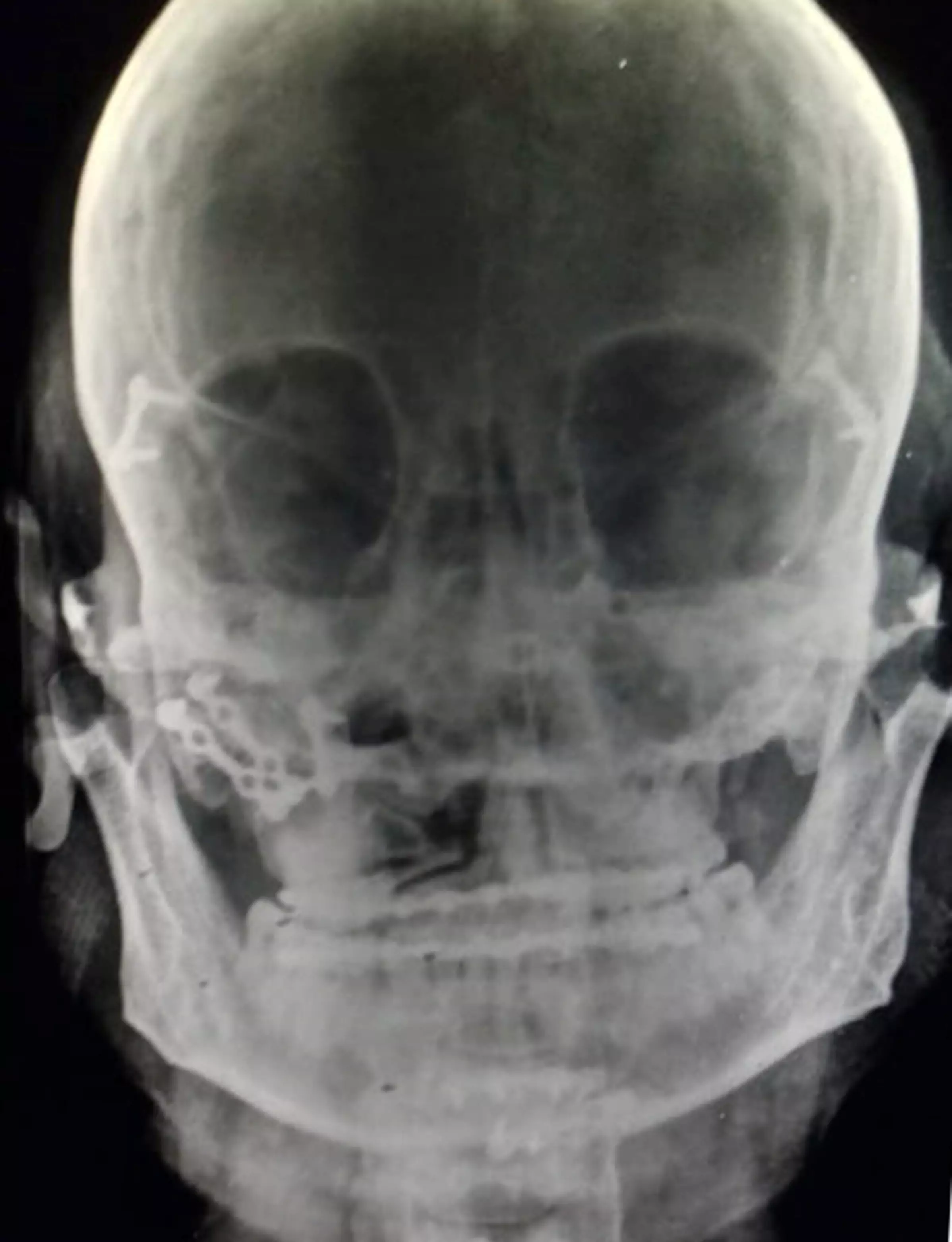 Here's an x-ray - you get the picture.