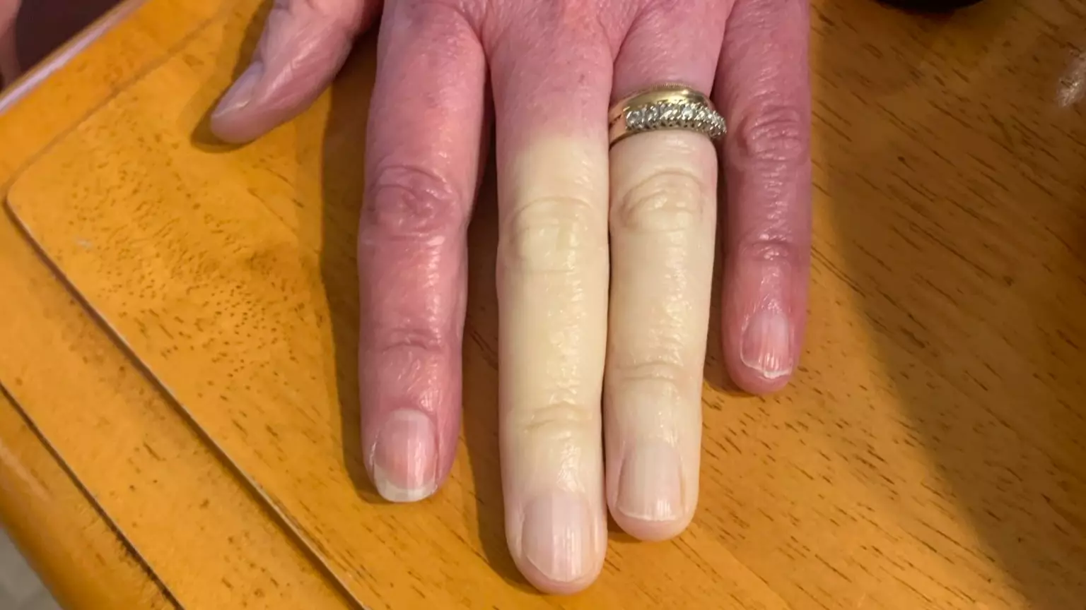 Mum's Fingers Turn Completely White Thanks To Rare Disorder