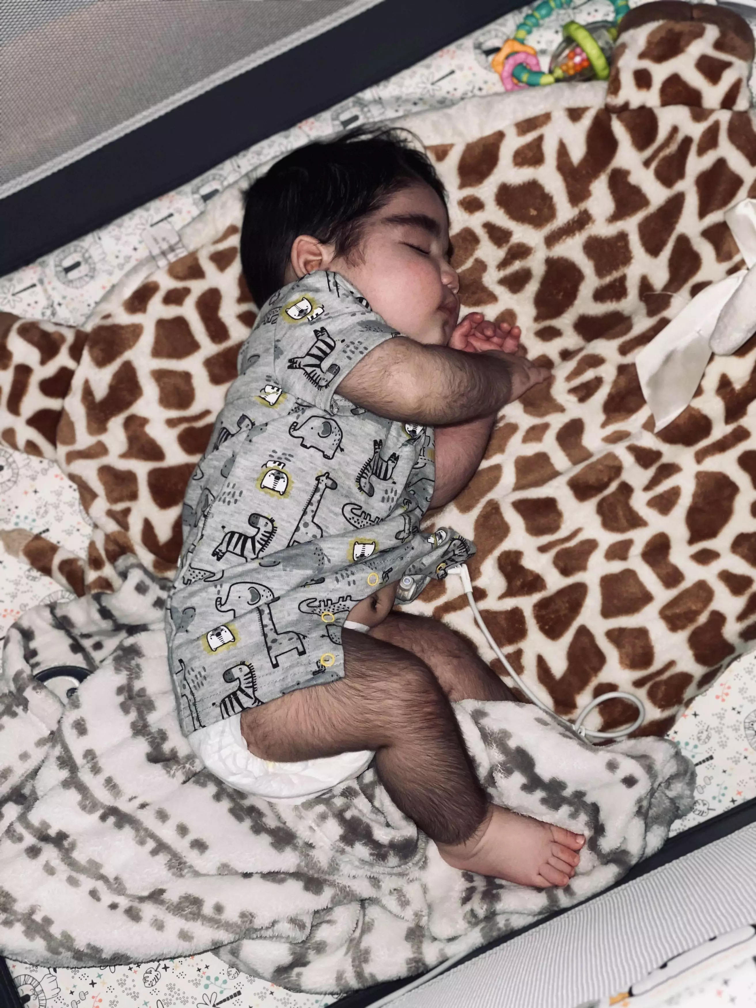Baby Mateo Hernandez has a rare condition Congenital Hyperinsulinism (