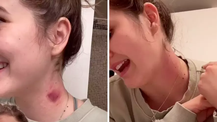 This Girl's Hack Gets Rid Of Hickeys In 5 Minutes