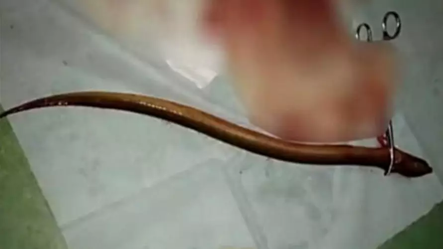 Man Sticks 19 Inch Swamp Eel Up His Arse To Cure Constipation