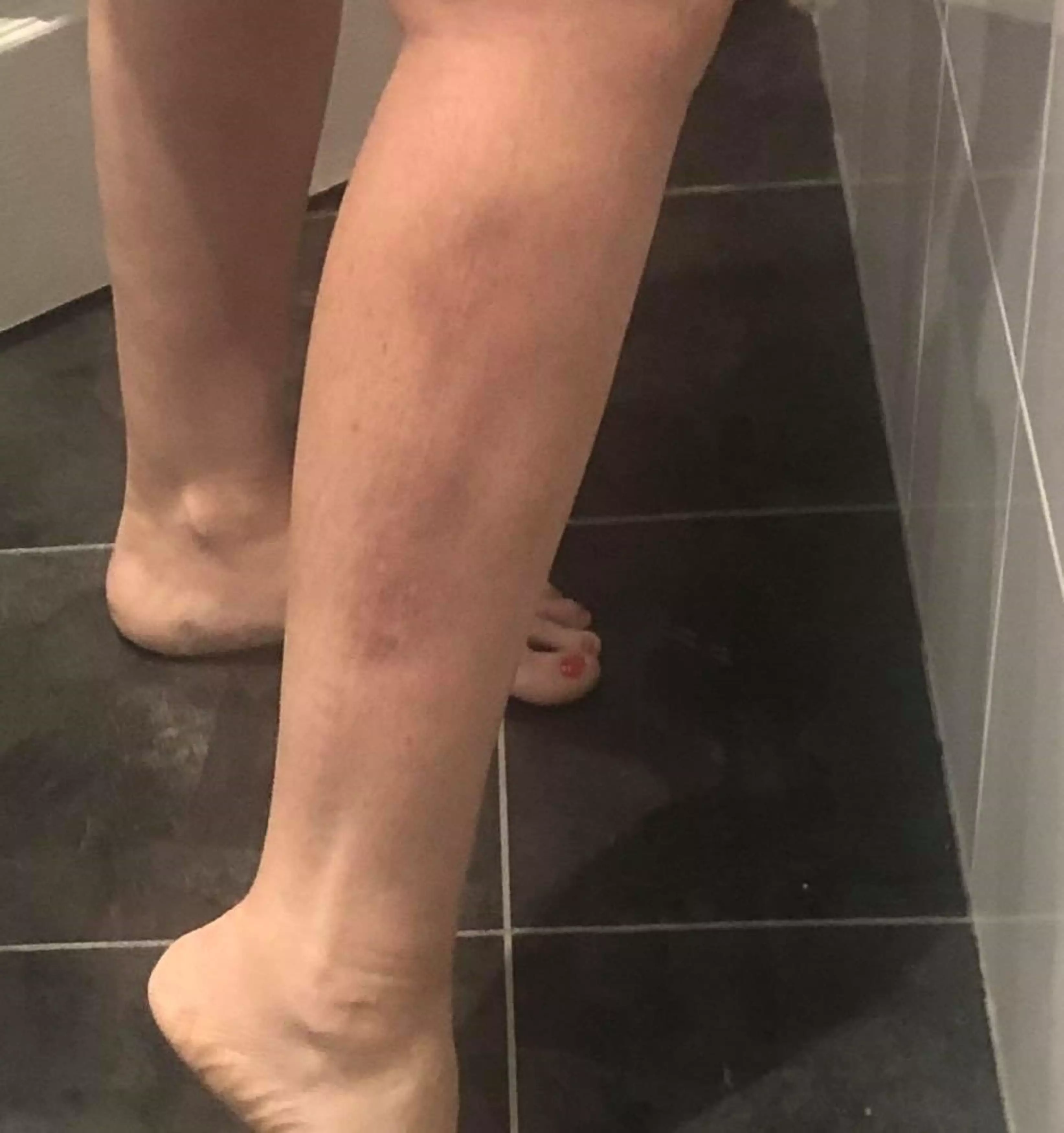 Caroline started noticing strange symptoms, like 'scar tissue' forming on her leg (