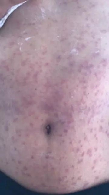 A rash from the caterpillars.