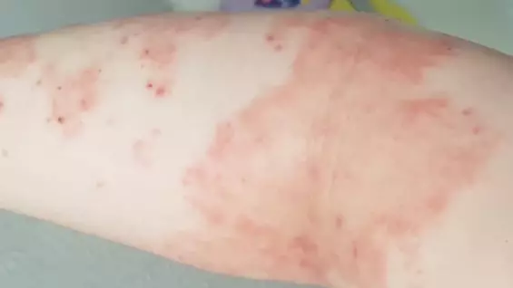 Woman Says Liz Earle Moisturiser Has Cleared Up Psoriasis In Four Weeks