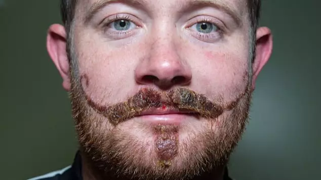 Leicester Man Left With Horrific Moustache Scar After Henna Tattoo Fail