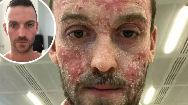 Man With Eczema Shows Incredible Transformation After Ditching Steroid Medication