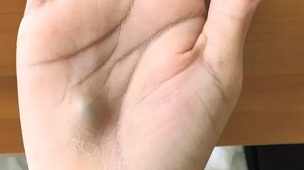 Man Develops Giant Blue Lump On Hand After Trip To Dentist