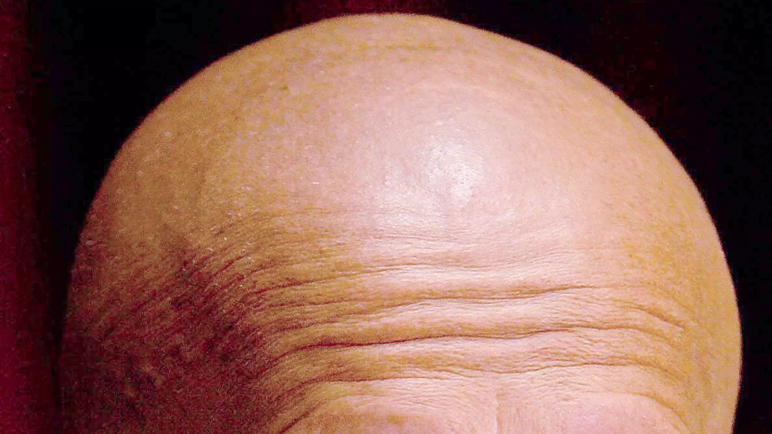 People Who Working Longer Hours Twice As Likely To Go Bald