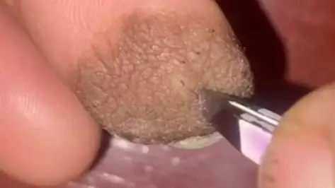 Woman Reveals Skin Graft Left Her With Pubes Growing Out Of Her Finger