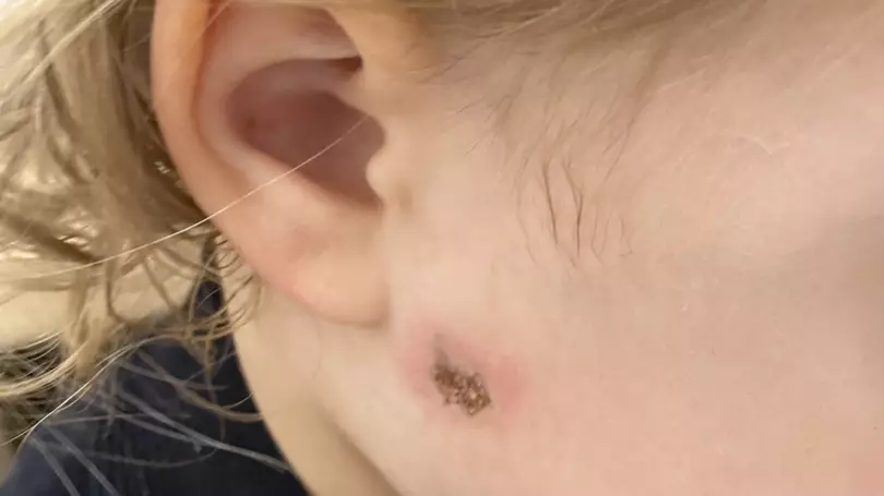Girl, 2, Burned By Firework That Was Thrown Into Garden By Stranger