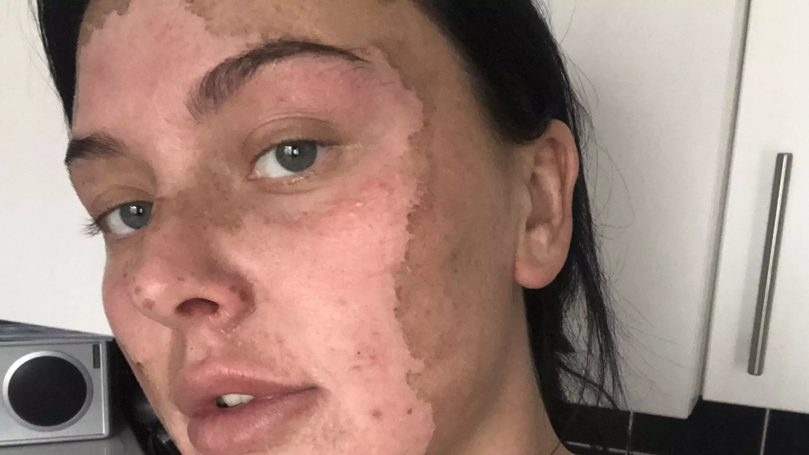 Woman Left With Burns After Egg Poaching Hack Goes Wrong