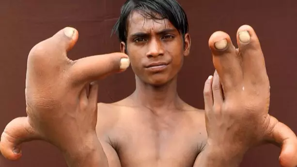 Doctors Are Baffled By This Indian Boy's Enormously Large Hands