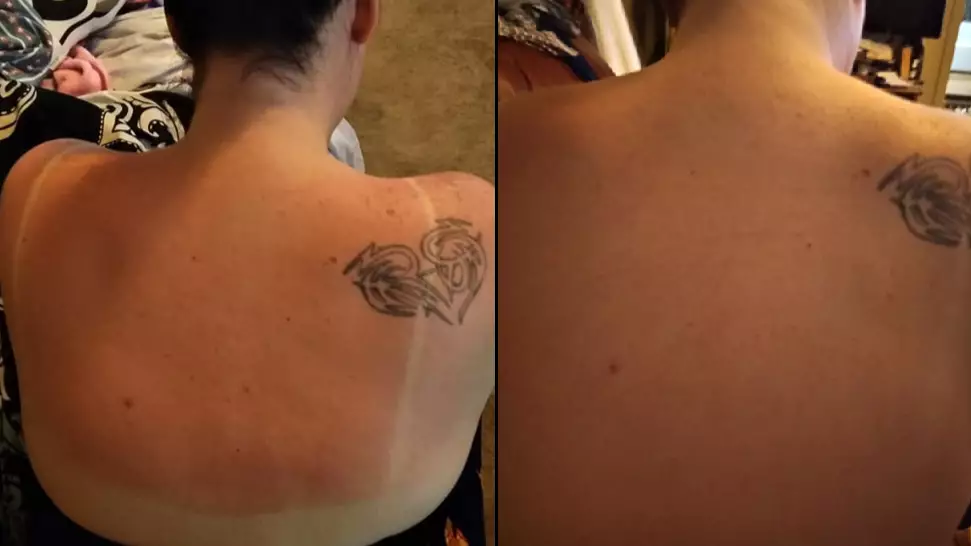 Woman Reveals Amazing 30 Minute 'Miracle' Cure For Sunburn