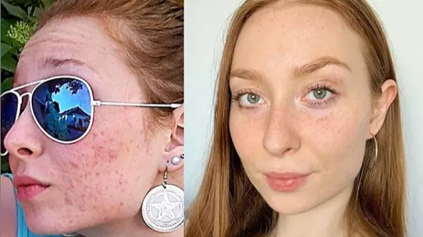 Woman Clears Up Acne By Going Vegan After Spending £10,000 On Treatments
