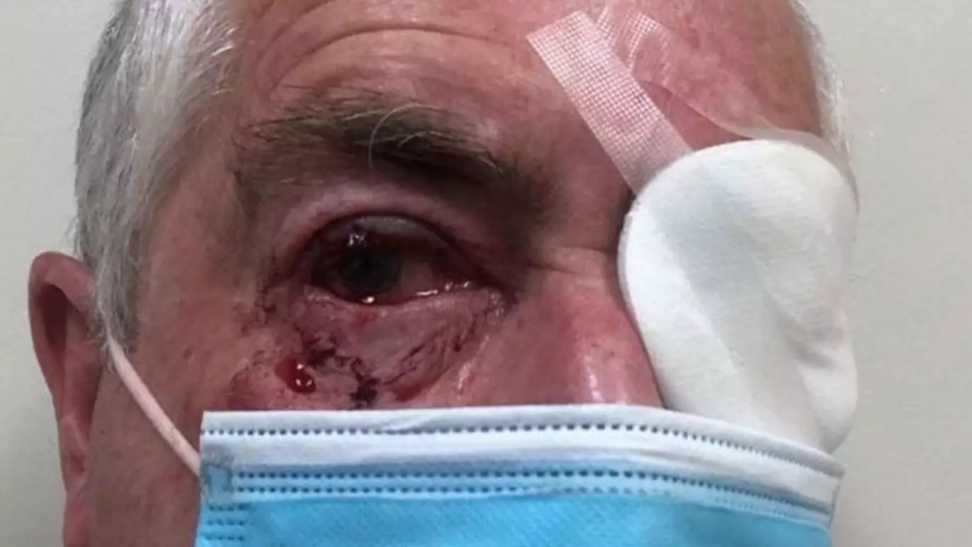 Elderly Aussie Man Narrowly Avoids Going Blind After Savage Magpie Attack