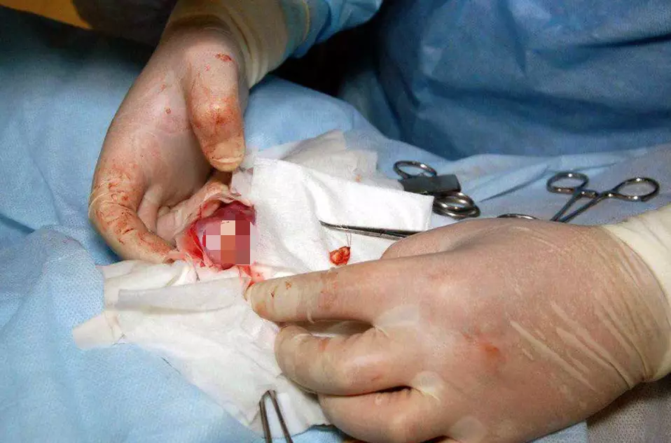 Doctors removed a tooth from the teen's ball.