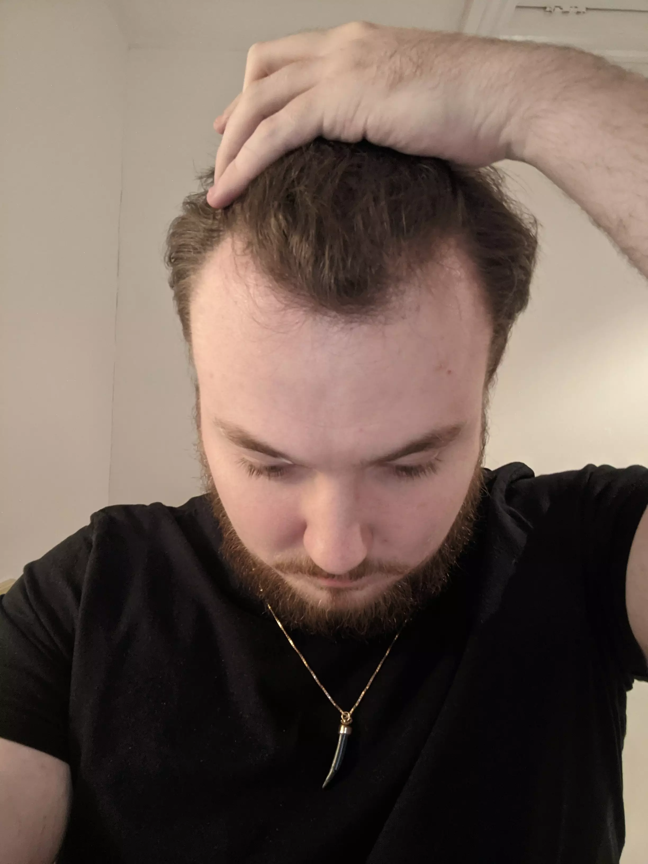 Myles is hoping to get a hair transplant.
