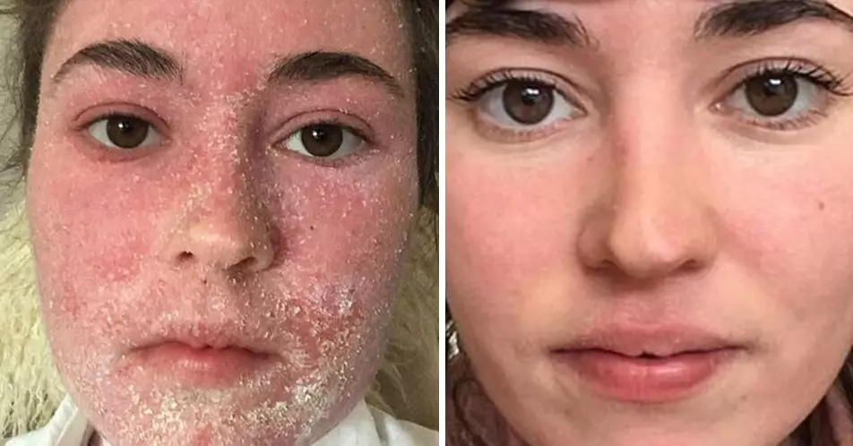 Woman Makes Incredible Eczema Recovery After Ditching Steroid Creams And Showers