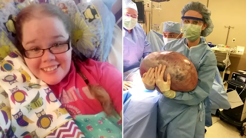 Woman Has 'Large Watermelon' Sized Cyst Removed From Her Ovary 