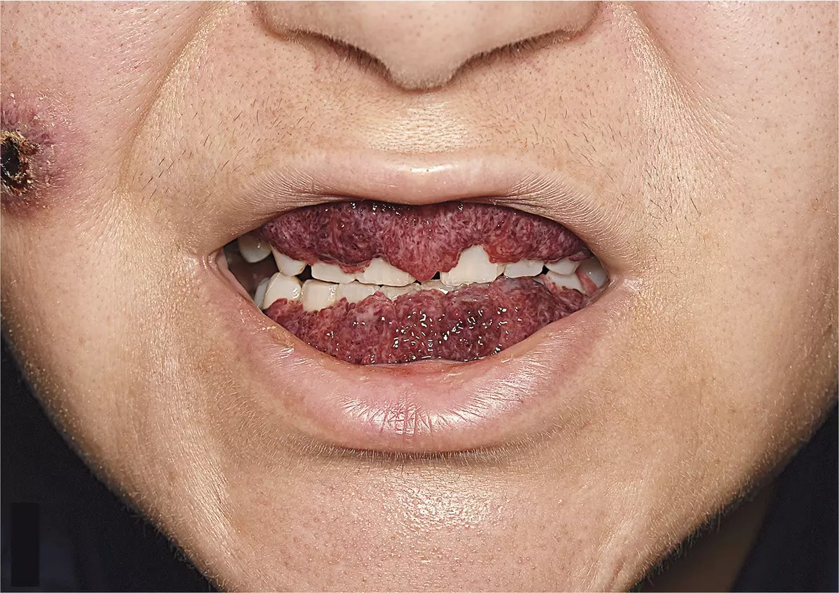 The 42-year-old's teeth became encased in overgrown gum.