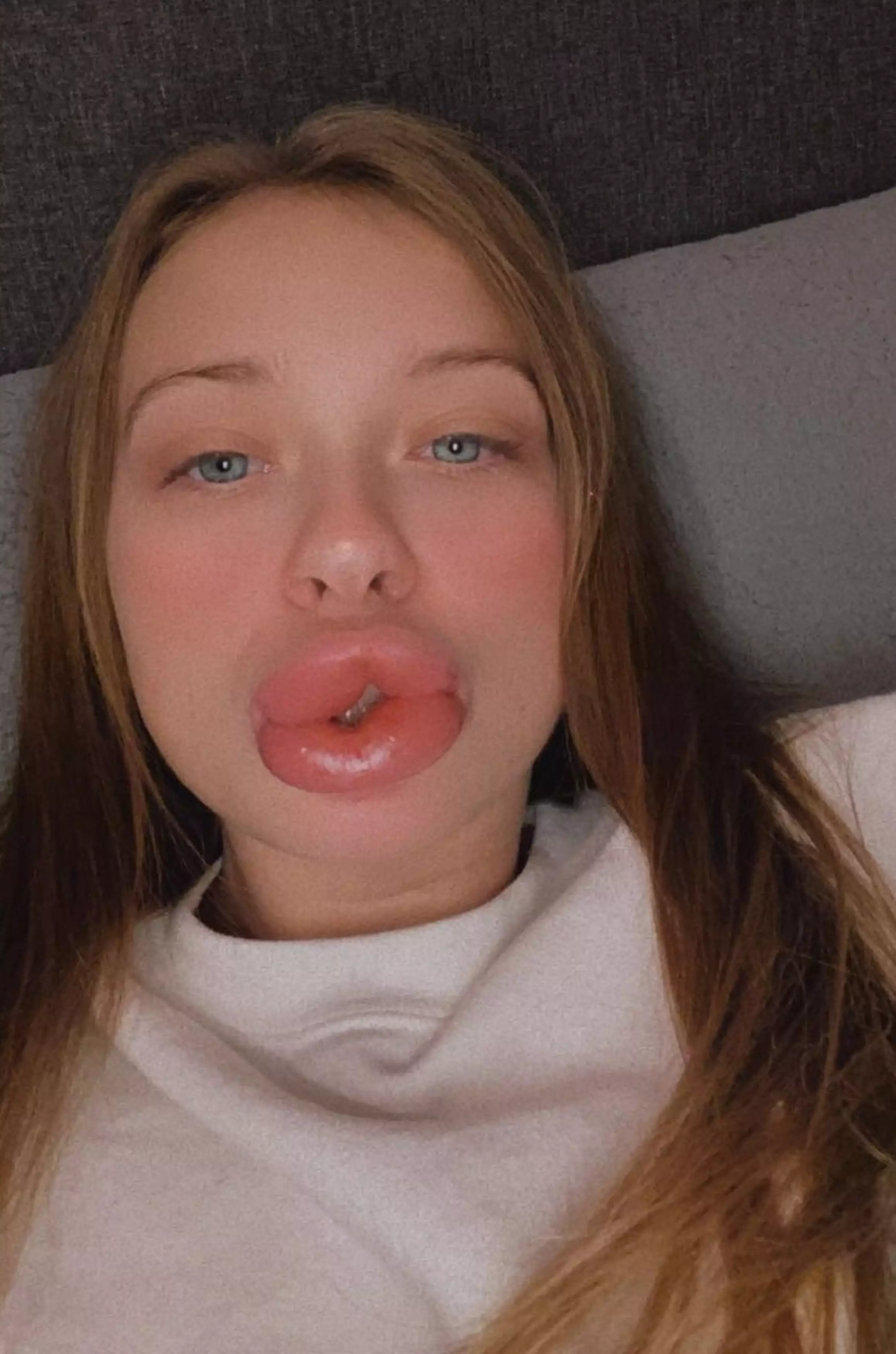 The 25-year-old wanted to get her 'small' lips filled to boost her confidence (