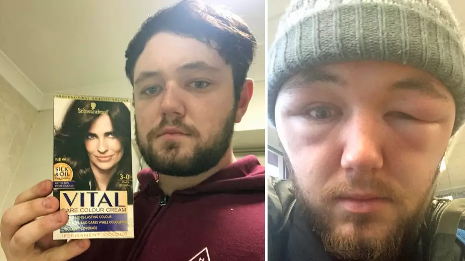 Man’s Face Dramatically Swells After Hair Dye Treatment Goes Horribly Wrong