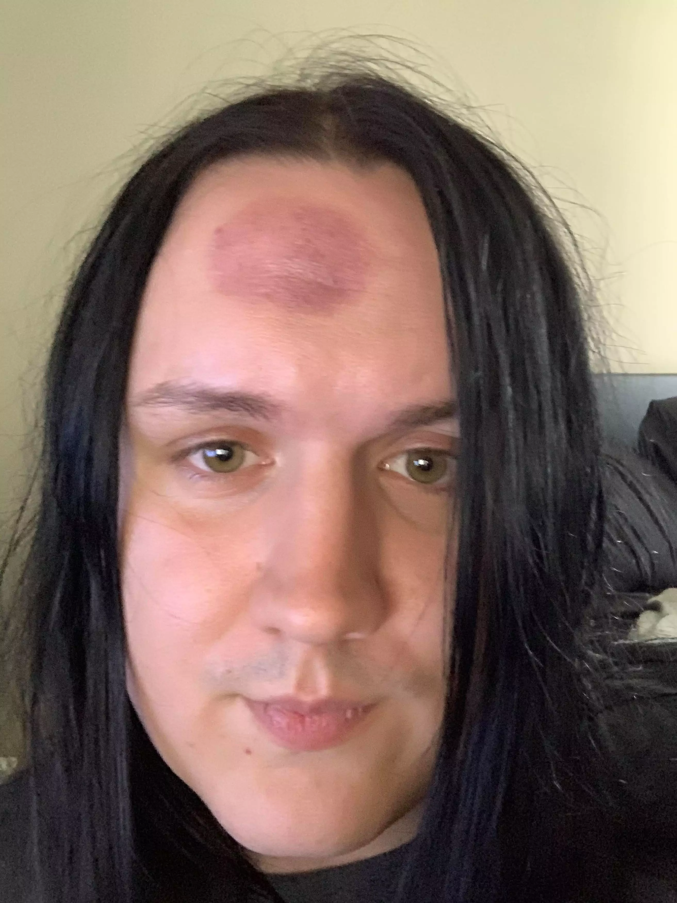 Michiah ended up with a massive bruise on his forehead.