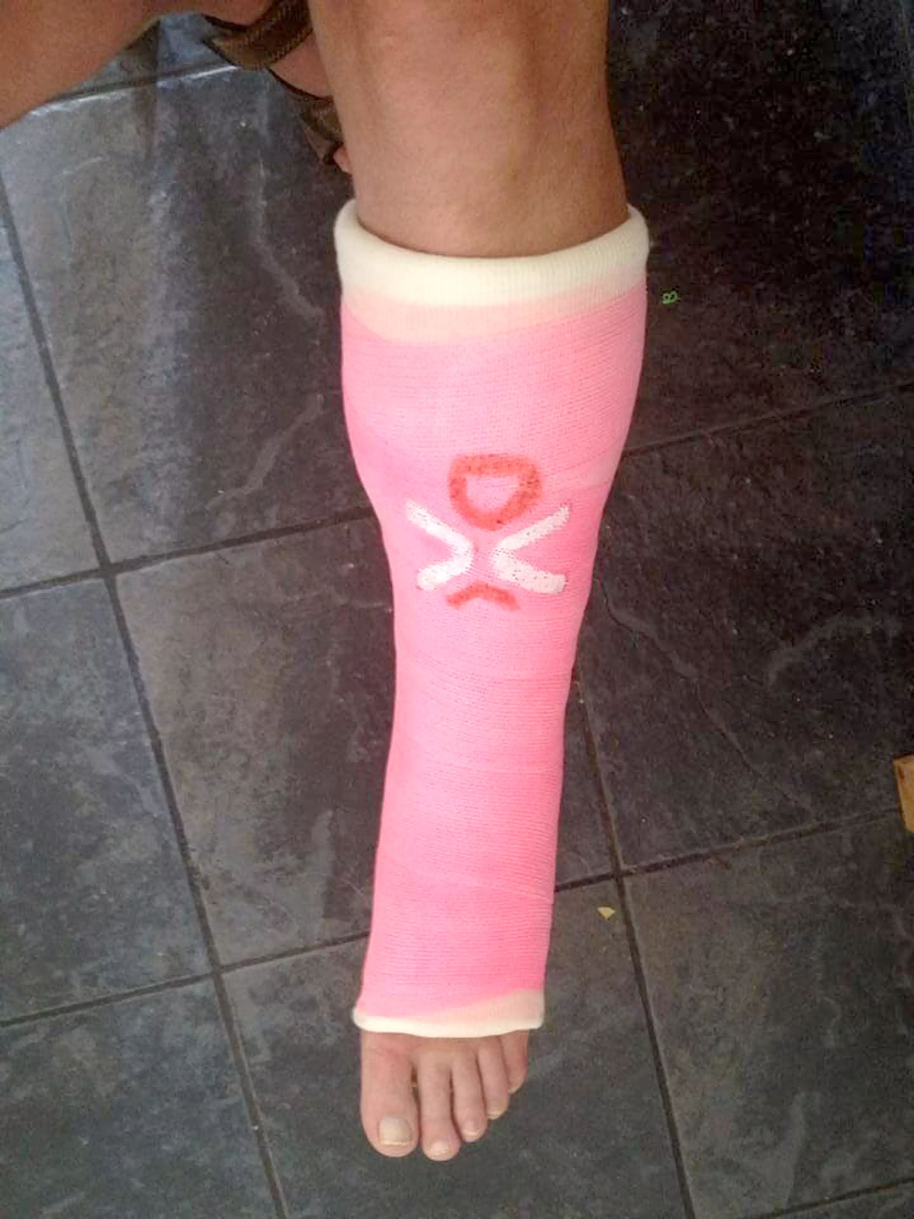Darren Jones' cast when he damaged his ankle.