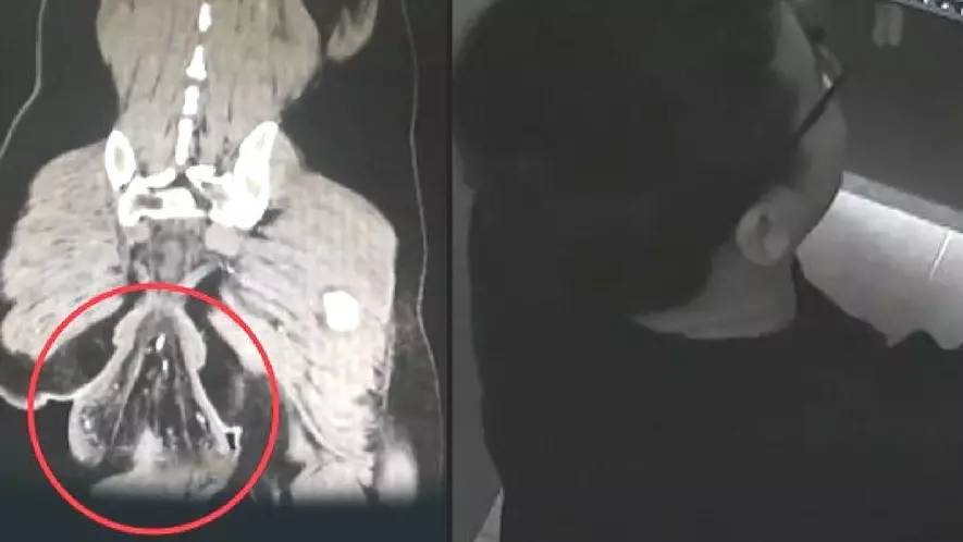 Man's Rectum Falls Out While He's Sat On The Toilet 
