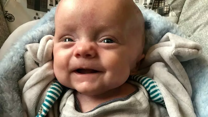 Baby Survives Despite Being Born Premature And With No Skin 