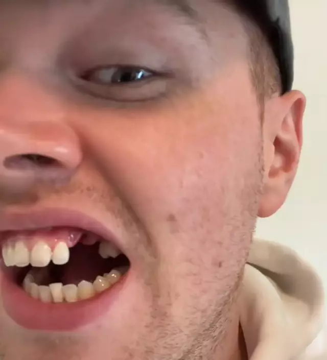 Disgusting Snus Horrible mouth condition that could arise from using white Snus