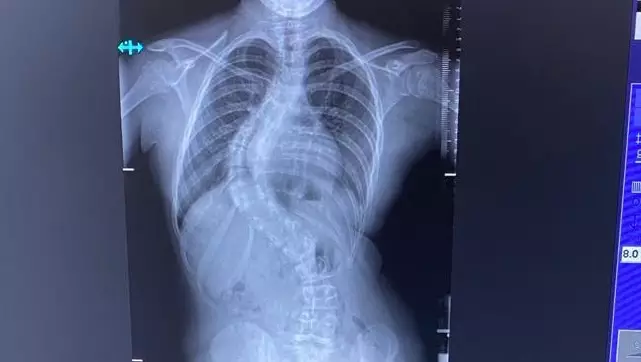 12-yr-old girl complains of back pain in UK, X-ray shows spine curved at 80-degree angle